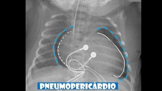 PNEUMOpericárdio
 