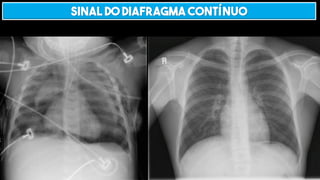Sinal do diafragma contínuo
 