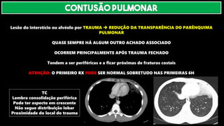 Lesão do interstício ou alvéolo por TRAUMA ➔ REDUÇÃO DA TRANSPARÊNCIA DO PARÊNQUIMA
PULMONAR
QUASE SEMPRE HÁ ALGUM OUTRO ACHADO ASSOCIADO
OCORREM PRINCIPALMENTE APÓS TRAUMA FECHADO
Tendem a ser periféricas e a ficar próximas de fraturas costais
ATENÇÃO: O PRIMEIRO RX PODE SER NORMAL SOBRETUDO NAS PRIMEIRAS 6H
TC
Lembra consolidação periférica
Pode ter aspecto em crescente
Não segue distribuição lobar
Proximidade do local do trauma
CONTUSÃO PULMONAR
 