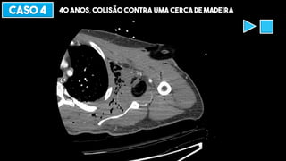 CASO 4 40 ANOS, COLISÃO CONTRA UMA CERCA DE MADEIRA
 