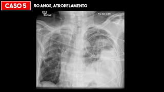 CASO 5 50 ANOS, ATROPELAMENTO
 