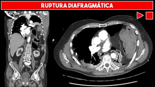 RUPTURA DIAFRAGMÁTICA
 