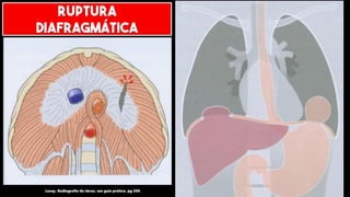 Lacey. Radiografia do tórax, um guia prático, pg 369.
RUPTURA
DIAFRAGMÁTICA
 