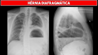 HÉRNIA DIAFRAGMÁTICA
 