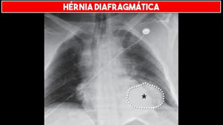 HÉRNIA DIAFRAGMÁTICA
 