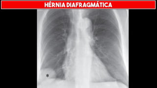 HÉRNIA DIAFRAGMÁTICA
 