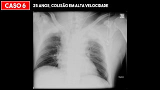 CASO 6 25 ANOS, COLISÃO EM ALTA VELOCIDADE
 