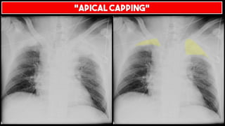 “APICAL CAPPING”
 