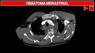 HEMATOMA MEDIASTINAL
 