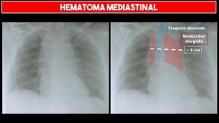 > 8 cm
Traqueia desviada
Mediastino
alargado
HEMATOMA MEDIASTINAL
 