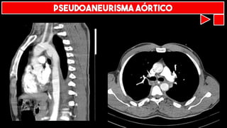 PSEUDOANEURISMA AÓRTICO
 
