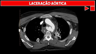 LACERAÇÃO AÓRTICA
 