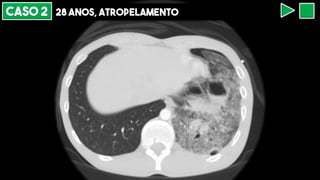 CASO 2 28 ANOS, ATROPELAMENTO
 