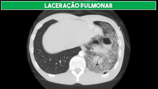 LACERAÇÃO PULMONAR
 