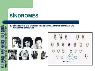 SÍNDROMES
1. SÍNDROME DE DOWN: TRISSOMIA AUTOSSÔMICA DO
CROMOSSOMO 21
 