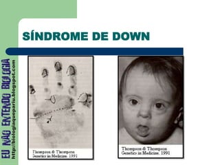 SÍNDROME DE DOWN
 