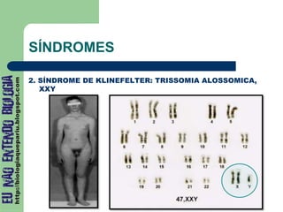 2. SÍNDROME DE KLINEFELTER: TRISSOMIA ALOSSOMICA,
XXY
SÍNDROMES
 