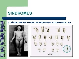 SÍNDROMES
3. SÍNDROME DE TUNER: MONOSSOMIA ALOSSOMICA, X0
 