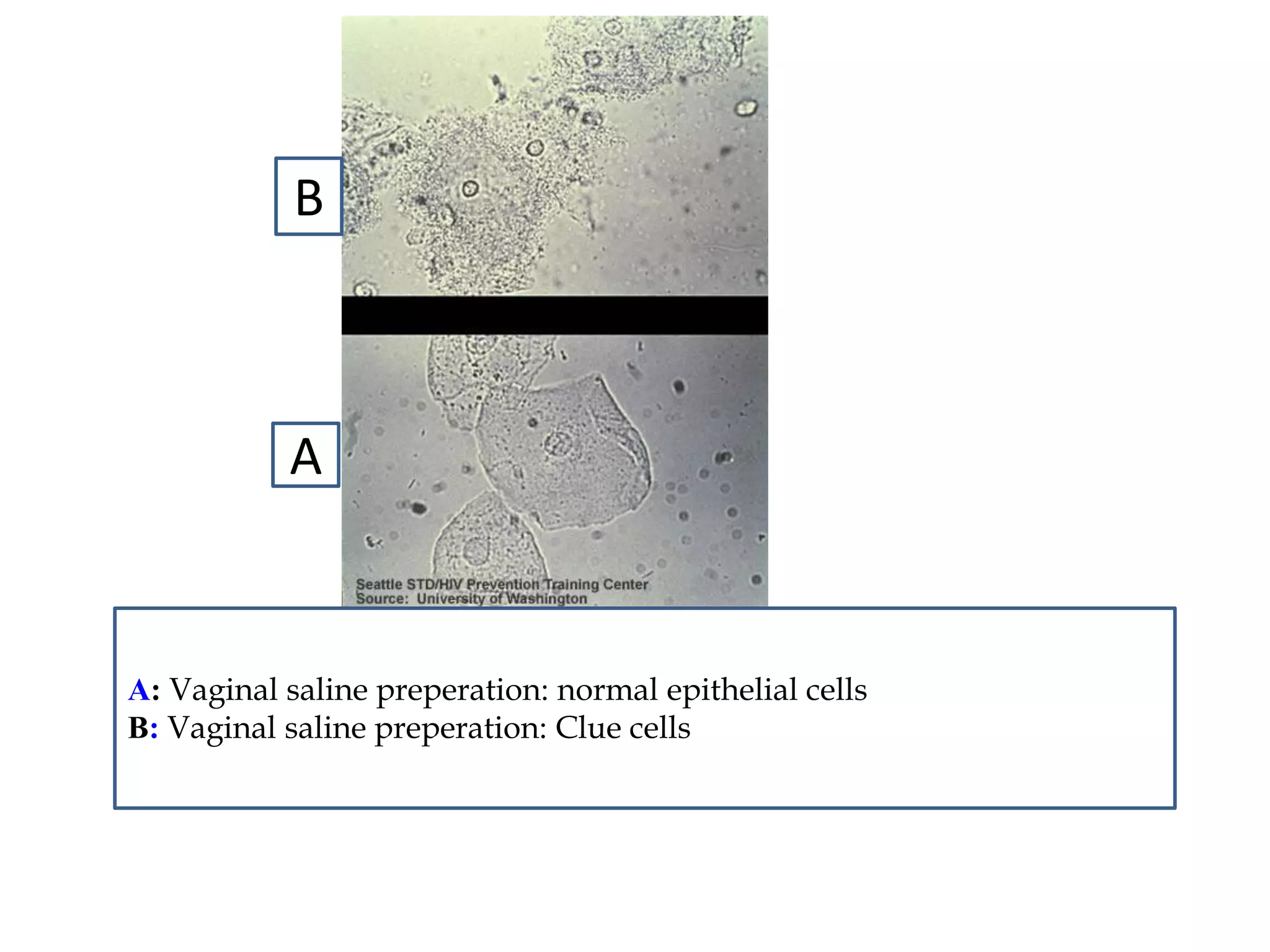A 
B 
A: Vaginal saline preperation: normal epithelial cells 
B: Vaginal saline preperation: Clue cells 
 