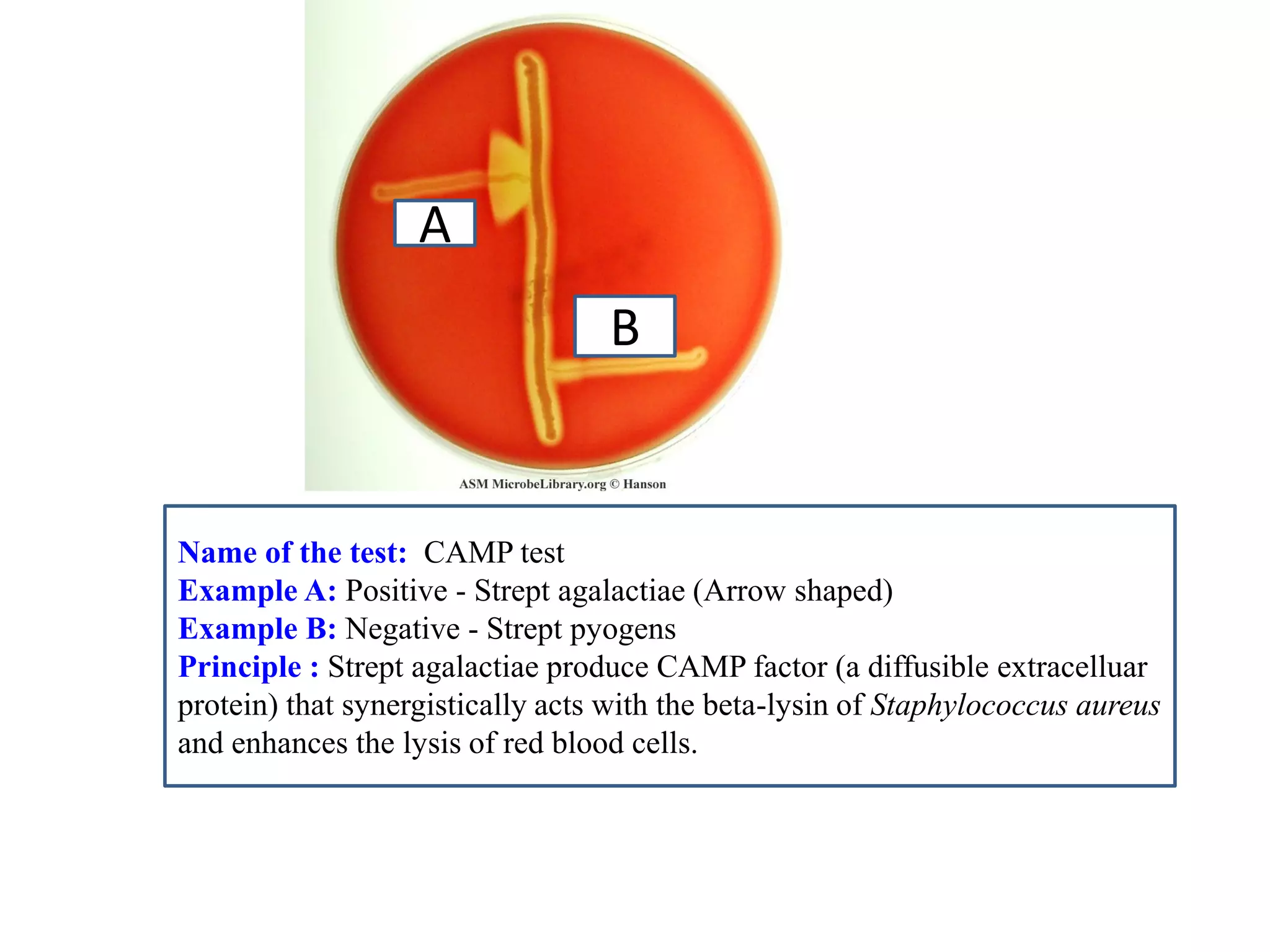 A 
B 
Name of the test: CAMP test 
Example A: Positive - Strept agalactiae (Arrow shaped) 
Example B: Negative - Strept pyogens 
Principle : Strept agalactiae produce CAMP factor (a diffusible extracelluar protein) that synergistically acts with the beta-lysin of Staphylococcus aureus and enhances the lysis of red blood cells.  