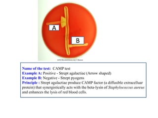A 
B 
Name of the test: CAMP test 
Example A: Positive - Strept agalactiae (Arrow shaped) 
Example B: Negative - Strept pyogens 
Principle : Strept agalactiae produce CAMP factor (a diffusible extracelluar protein) that synergistically acts with the beta-lysin of Staphylococcus aureus and enhances the lysis of red blood cells.  