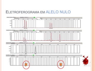 Eletroferogramaem ALELO NULO