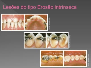 Lesões do tipo Erosão intrínseca
FONTE:
Baratieri,2002
FONTE:
Baratieri,2002
FONTE:
Baratieri,2002
 