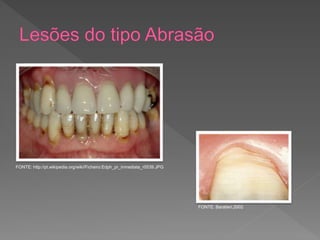 FONTE: Baratieri,2002
FONTE: http://pt.wikipedia.org/wiki/Ficheiro:Edph_pr_inmediata_r0539.JPG
 