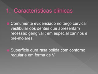  Comumente evidenciado no terço cervical
vestibular dos dentes que apresentam
recessão gengival ; em especial caninos e
pré-molares.
 Superfície dura,rasa,polida com contorno
regular e em forma de V.
 