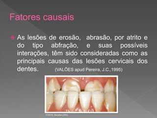 Fatores causais
 As lesões de erosão, abrasão, por atrito e
do tipo abfração, e suas possíveis
interações, têm sido consideradas como as
principais causas das lesões cervicais dos
dentes. (VALÕES apud Pereira, J.C.,1995)
FONTE: Baratieri,2002
 