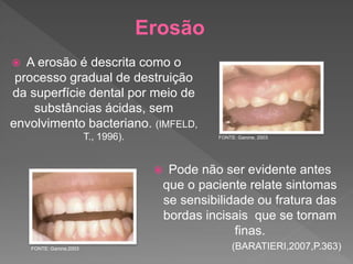 Erosão
 A erosão é descrita como o
processo gradual de destruição
da superfície dental por meio de
substâncias ácidas, sem
envolvimento bacteriano. (IMFELD,
T., 1996).
 Pode não ser evidente antes
que o paciente relate sintomas
se sensibilidade ou fratura das
bordas incisais que se tornam
finas.
(BARATIERI,2007,P.363)
FONTE: Garone, 2003
FONTE: Garone,2003
 
