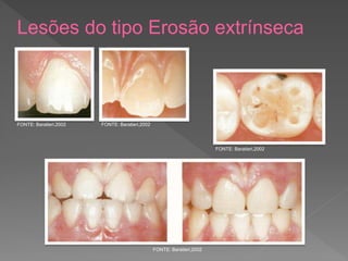 Lesões do tipo Erosão extrínseca
FONTE: Baratieri,2002 FONTE: Baratieri,2002
FONTE: Baratieri,2002
FONTE: Baratieri,2002
 