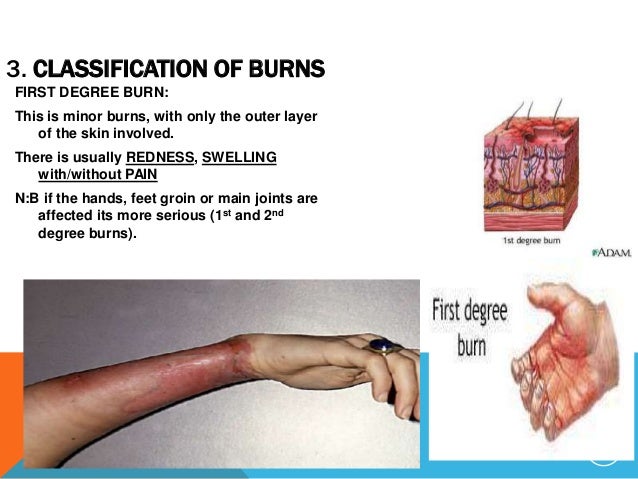 1st And 2nd Degree Burns Fingers - 638x479 - jpeg 1st And 2nd Degree Burns Fingers
