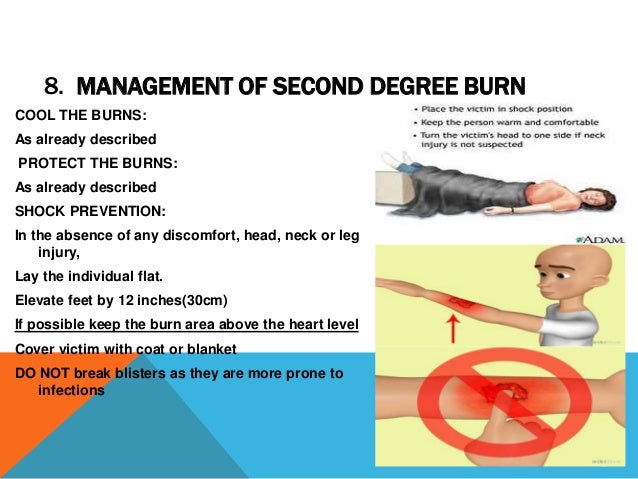 What is the first aid treatment for first degree burns?