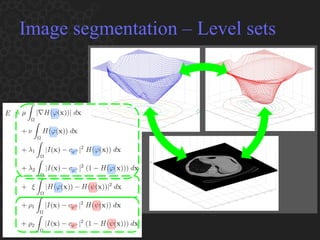 Image segmentation – Level sets 