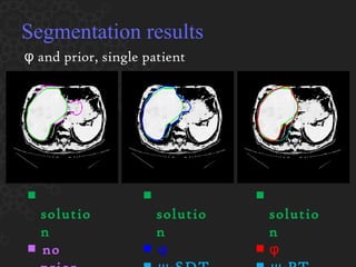 Segmentation results ■  solution  ■  no prior ■  solution  ■  φ   ■  ψ -SDT ■  solution  ■   φ   ■  ψ -PT φ  and prior, single patient 