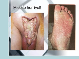 Micose horrível!
 