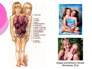 Abigail and Brittany Hensel,
Minnesota, EUA
 