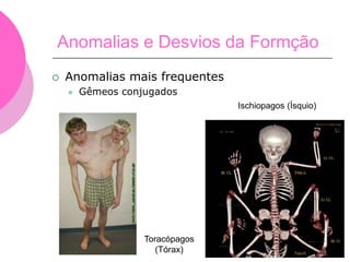 Ischiopagos (Ísquio)
Toracópagos
(Tórax)
 Anomalias mais frequentes
 Gêmeos conjugados
Anomalias e Desvios da Formção
 