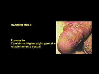 CANCRO MOLE Prevenção Camisinha. Higienização genital antes e após o relacionamento sexual.   