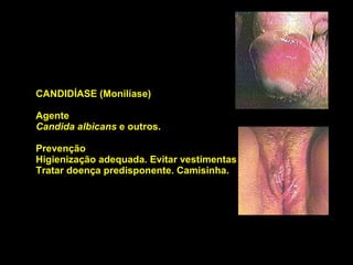 CANDIDÍASE (Monilíase)  Agente Candida albicans  e outros.  Prevenção Higienização adequada. Evitar vestimentas muito justas. Tratar doença predisponente. Camisinha.  
