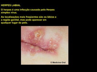HERPES LABIAL O herpes é uma infecção causada pelo Herpes simplex vírus. As localizações mais freqüentes são os lábios e a região genital, mas pode aparecer em qualquer lugar da pelo. 