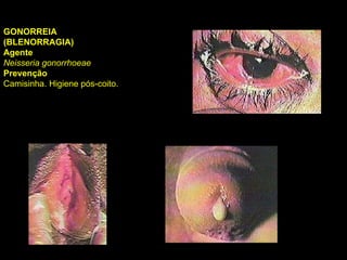 GONORREIA (BLENORRAGIA) Agente Neisseria gonorrhoeae   Prevenção Camisinha. Higiene pós-coito.  