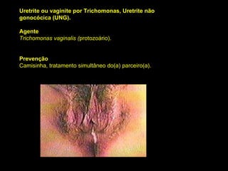 Uretrite ou vaginite por Trichomonas, Uretrite não gonocócica (UNG).  Agente Trichomonas vaginalis ( protozoário).  Prevenção Camisinha, tratamento simultâneo do(a) parceiro(a).  