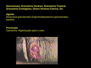 Danovanose, Granuloma Venéreo, Granuloma Tropical, Granuloma Contagioso, Úlcera Venérea Crônica, etc . Agente Donovania granulomatis (Calymmatobacterium granulomatis).  bactéria Prevenção Camisinha. Higienização após o coito. 