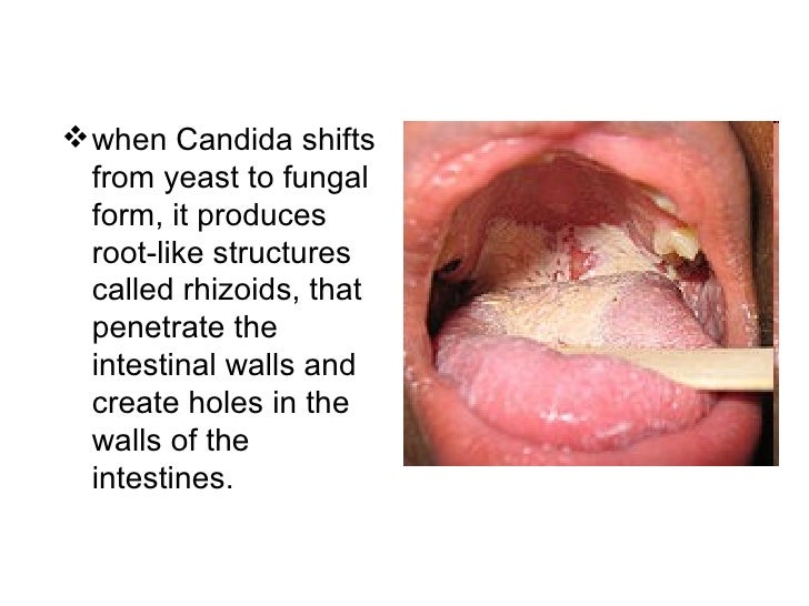 Why Candida Yeast Infection Can Be Dangerous
