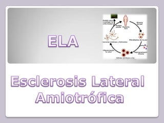 ESCLEROSIS LATERAL AMIOTROFICA (ELA)