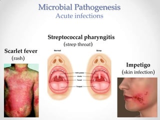 Strep. Pyogenes Infant The Toxic Invasion of Streptococcus pyogenes | PPTX