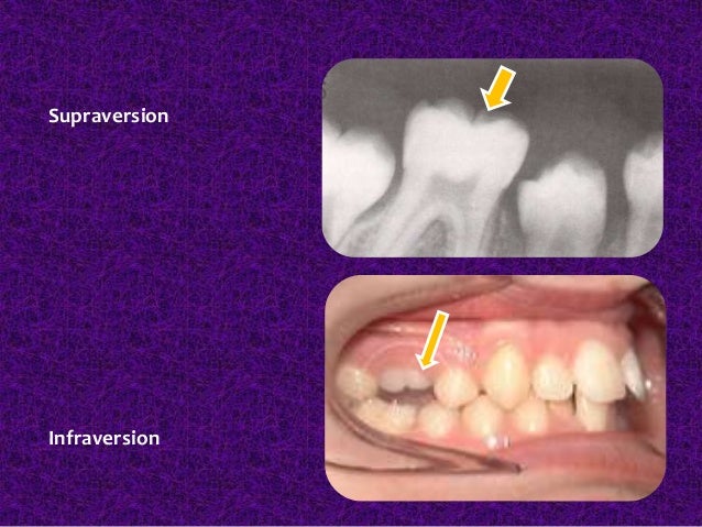 classification of malocclusion