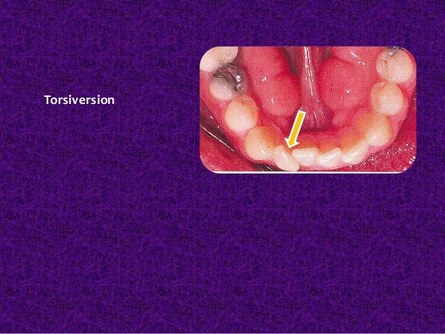 classification of malocclusion